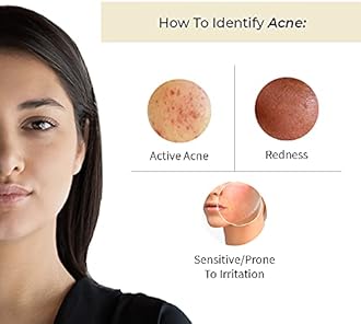 Vedix Face Serum, Customised Ayurvedic Prakhya Acne Rescue Face Serum for Acne Prone Skin With Aloe Vera + Vacha + Bakuchi - 20 ml