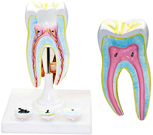 Modelo Dental - Tallada Herramientas De Demostración Modelo De La Caries Dental como Un Modelo De Aprendizaje O Una Herramienta De Investigación