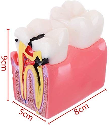 Insegnamento del Modello di Anatomia Dentale Educazione per Studenti di Odontoiatria E Ricerca sulle Carie 6 Volte Studio Comparativo del Modello 1 Strumento Assistente di Biologia Anatomica