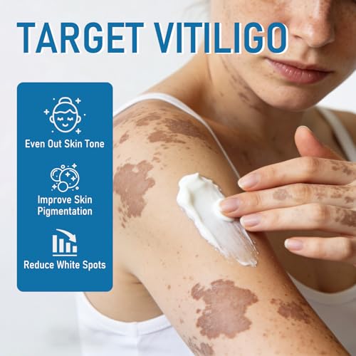 Qpywd Vitiligo Cream for Men & Women, Vitiligo Treatment Cream, Effective Vitiligo Cream for Pigmentation & White Spots, Natural Formula, Gentle on All Skin, 20g