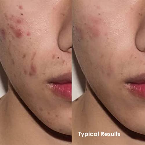 Tinted Moisturizer For Men By Apricus Skincare | Face Moisturizer Anti Aging And Anti-Redness | Dark Spot Concealer Cream And Redness Corrector | Matte Acne Face Moisturizer, 0.67 Oz, (Medium) #TOP4