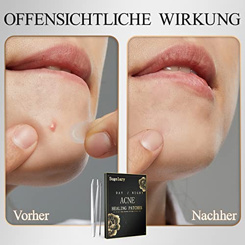 252 Akne Pimple Patch, Tag & Nacht besteht Sie 2-in-1-Akne Absorbierende Pickel Pflaster Unsichtbare Wirksame Hydrokolloid-Akne Pickel Pflaster Wasserdichte und Atmungsaktive Akne Pickelpflaster