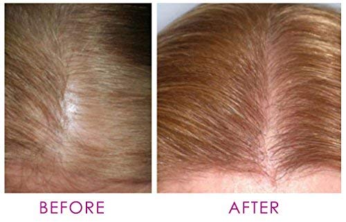 Anti Hair Loss Growth Treatment Women Men W Ginger Royal Jelly By Sorrel Cosmetics Thinning Scalp Ampollas Anti Caida Drops Caida Del Cabello Regrowth Serum Botanical Hibiscus 12 X 10Ml #TOP2