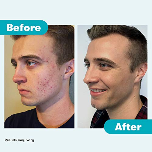Proactiv 3 Step Acne Treatment - Benzoyl Peroxide Face Wash, Repairing Acne Spot Treatment For Face And Body, Exfoliating Toner - 30 Day Complete Acne Skin Care Kit #TOP5