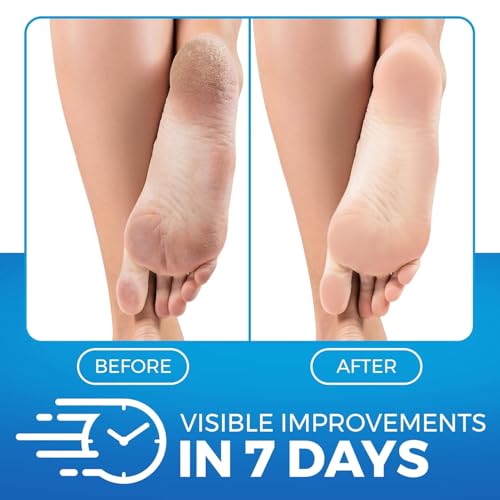 Imperial Feet Urea Foot Balm - Natural Urea Cream for Foot Care, Cracked Heel Repair, Rough Skin, Dryness, Calluses - Cleansing, Exfoliant - Wild Herb Extract - 5.07oz