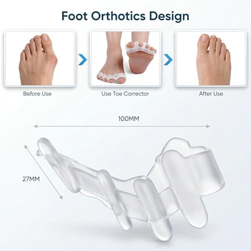 Image of Cetaplast Bunion Corrector and Toe Straightener (2 Pairs) - Medical Grade Silicone Toe Separators for All-Day Pain Relief & Alignment - Includes Pairs for Gentle Start & Active Stretch Support for Men & Women