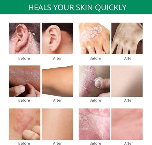Hermon Psoriasis Eczema Relief Cream: Maximum Strength for Psoriasis Eczema - Relieve Symptom of Resistant Effective for Seborrheic Dermatitis Folliculitis 100m 3.4 Fl Oz (Pack of 1)