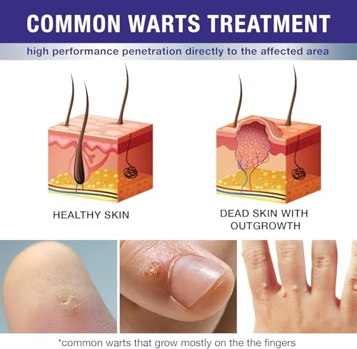 Image of Dr. Luke Foot Corn Removers for Toes & Finger: Deep Corn Removal for Feet & Hand - Fast Acting 17% Salicylic Acid Corn Removers for Feet Hand Corn, Plantar Wart, Common Wart - 0.5 Ounce (Pack of 1)
