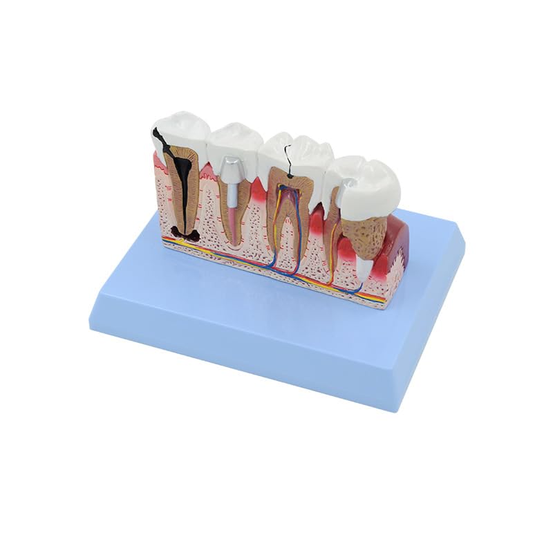 Dente Dentale Patologia Modello Anatomico Scienze Mediche Risorse Didattiche Dropshipping