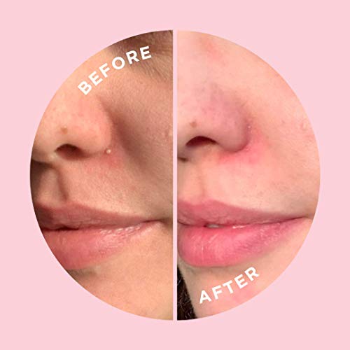 Zitsticka Goo Getter | Hydrocolloid Patch For Covering Zits And Blemishes | At-Home Extractions Without Scarring For Zits That Have Come To The Surface (36 Pack), Exfoliating, Moisturizing #TOP6