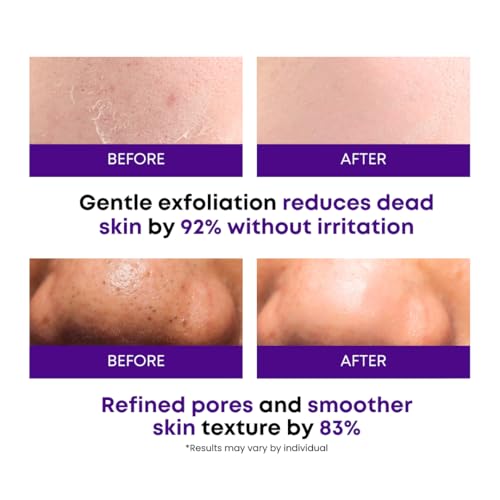 Image of Eggplant Peeling Toner Pads - Korean Toner Pads Exfoliating, Dual Action for Pore Care & Skin Barrier, Improves Rough and Dull Skin, Removes Dead Skin & Blackheads, Dual Side Cotton, 50 Pad