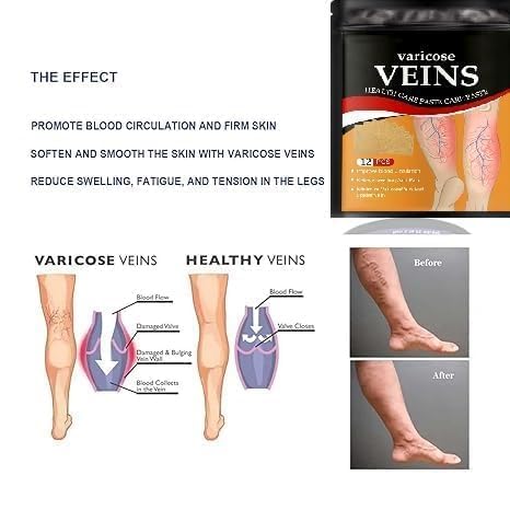 Image of Varicose Veins Relief Patches - 12 PICE | Reduces Swelling, Relieves Pain, Improves Blood Circulation & Vein Health | Herbal, Skin-Friendly & Instant Pain Relief (pack of 2)