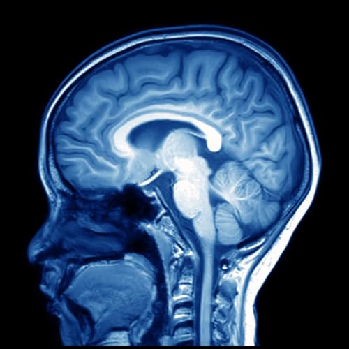 Medical Care the prime cause of the Alzheimer's Epidemic? Why Brain Health starts with Chiropractic Care