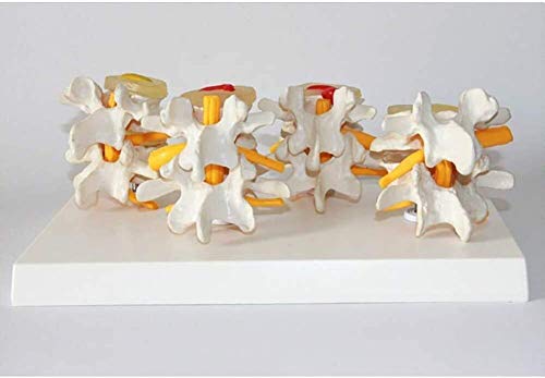 QIQIZHANG Anatomy Model, Osteoporosis Vertebrae Anatomical Model Human Lumbar Lesion Spine Statue Display Model Lumbar Vertebra Spine Diseased Model 4-Stage 10 for Medical Demonstration