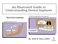 Illustrated Guide to Understanding Dental Implants Root Form 0963809504 Book Cover