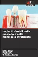 Impianti dentali nella mascella e nella mandibola atrofizzate (Italian Edition) 6203919381 Book Cover