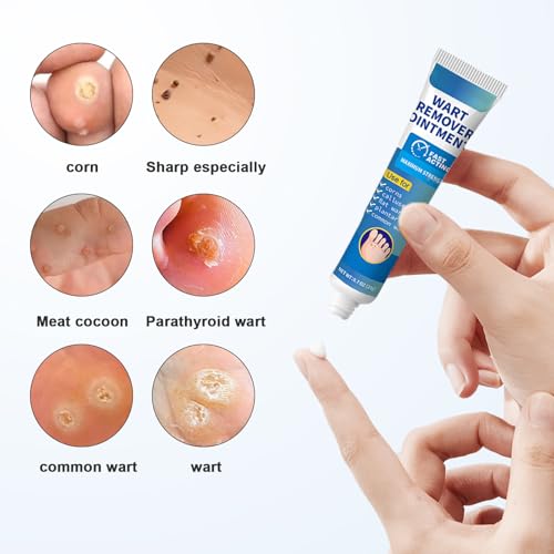 Wart Remover Ointment with 17% Salicylic Acid for Common, Flat, Plantar Warts and Corns (Blue) - Image 3