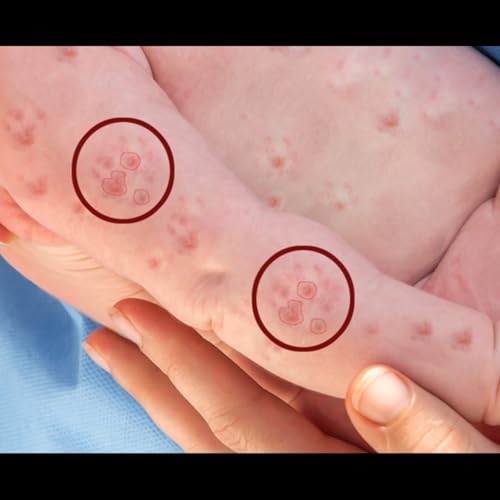 Measles Outbreak Sparks Alarm