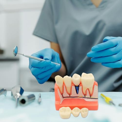 Modèle d'implant dentaire pour résoudre les erreurs d'analyse de pont - 7