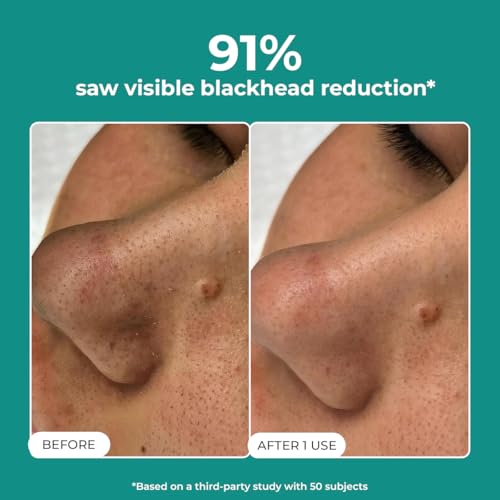 Image of Conscious Chemist Blackhead Melting Water | 50ml | Gentle Pore treatment with Succinic, Glycolic Acid & CICA Exosome | Unclogs Pores, Dissolves Blackheads & Smoothens Skin | Toner For Men & Women
