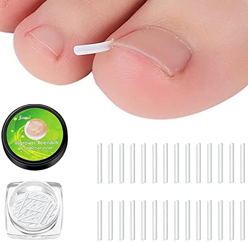 Wancala 20pcs Ingrown Toenail TreatmentandIngrown Toenail Corrector Kit,Ingrown Toenail Groove Ingrowing Toenail Patch Ingrown Toenail Tool Treament Women Foot Nail Care Tool,White
