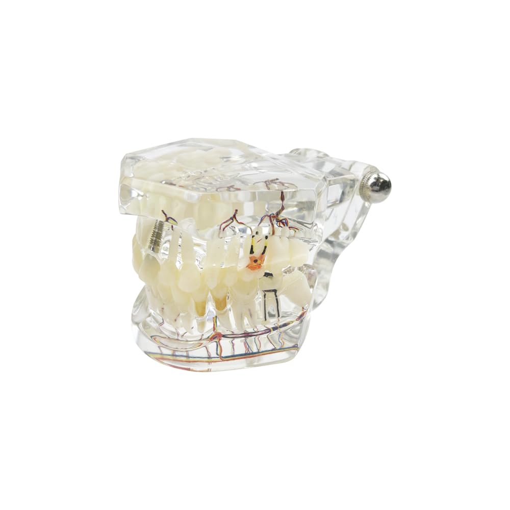 Modello dentale di riparazione neurale Modello dentale Malattia dell'impianto Modello dei denti Dentista Modello di insegnamento patologico standard dei denti rimovibili