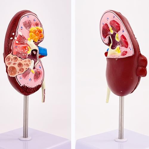 Modèle de pathologies rénales anatomique double face pour bureau médical - 7