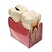 Dental Caries Tooth Model, YOUYA DENTAL 6 Times Caries Tooth Model Dental Anatomy Education Tooth Model Decay Teeth Comparative Study Model Teaching Typodont Model for Dentists Student Education