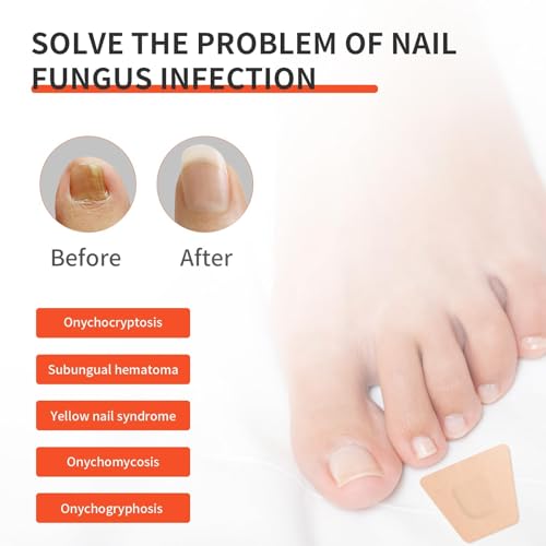 image for Method Toenail Fungus Treatment Extra Strength,Toe Nail Fungus Treatme