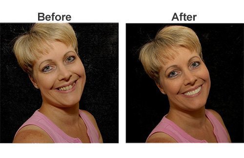 image for Imako Cosmetic Teeth for Women 1 Pack. (Small, Bleached) Uppers Only- 