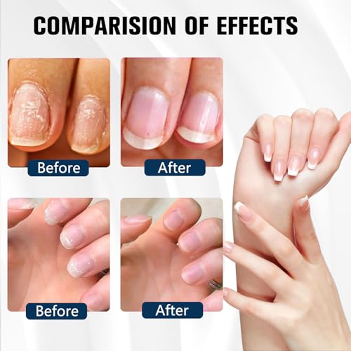 Nail Spray, Toe Nail Care Treatment Spray, Keeps Feet Fresh & Dry All Day for All Nail Types, 2 PCS - Thumbnail 6