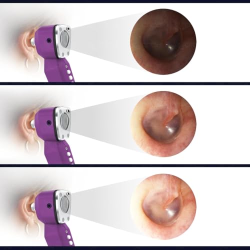 Image of OTICA 3.7V Professional Diagnostic Pocket LED Otoscope | Rechargeable In-Built 3500mAh Battery | Type-C Charging | Adjustable Intensity | 10 Disposable Specula + Spare Glass | 11707 - Purple