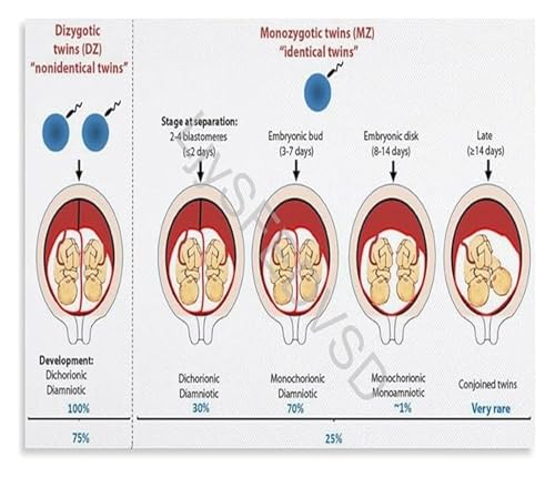 Twin Pregnancy Anatomy Canvas Wall-Art Placentation Process Educational Chart for Birth Professionals Midwife Gift Decor(Framed,