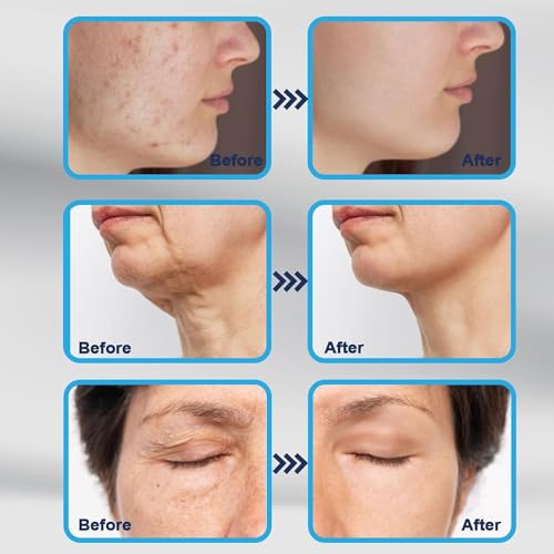 Image of JICOOT Derma Stamp For Women and Men | Microneedling Pen For Face, Microneedle Derma Roller, Dermastamp for Beard Microneedling Pen Roller Micro Needle Roller For Face Scalp