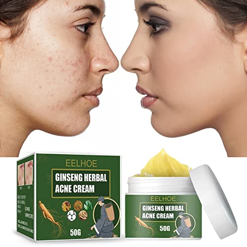 herommy Crema de espinillas para la Cara,Crema de Manchas de Aloe Vera para Limpiar Manchas severas - Tratamiento Natural para Manchas para Todo Tipo de Piel, Crema para Cicatrices eficaz de Alta