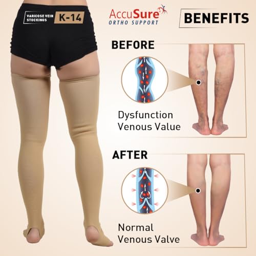 Image of AccuSure Medical Compression Varicose Vein Stockings (Anatomical Shape,Easy to use, Non Slippagen, Durable)-Thigh Length for Varicose Veins Can Be Used By Men & Women