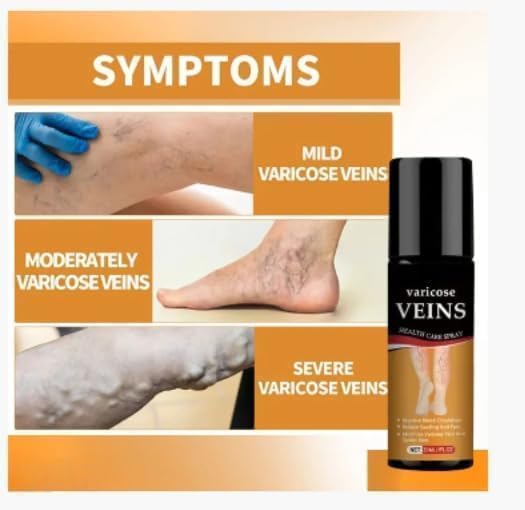 Image of Varicose Veins Spray - Natural Herbal Formula for Fast Relief | Reduces Swelling, Relieves Pain & Promotes Blood Circulation | Easy-to-Use Spray for Legs, Ankles & Feet (PACK OF 2, 60 ML)