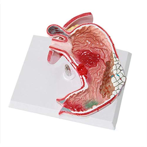 Modelo Anatômico de Estômago Humano Mudanças Patológicas Anatomia para Sala de Aula Estudo Modelo Mé