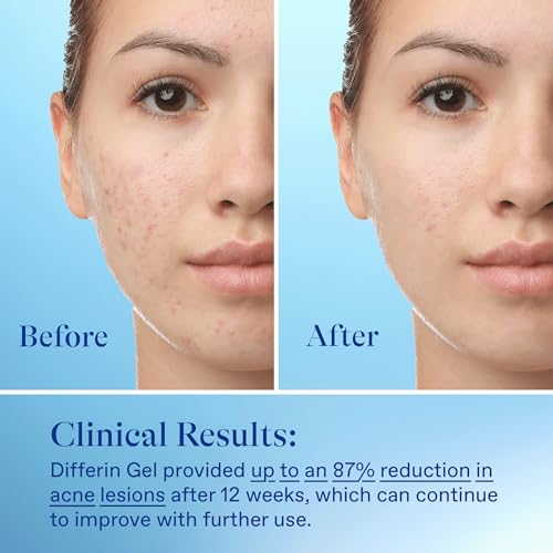 Thumbnail image for Differin Acne Treatment Gel