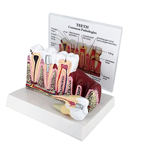 Dental Model Human Body Anatomy Detachable Tooth Anatomy Model Medical Teaching Model Dental Tooth Model Replica of Teeth W/Common Pathologies Patient Education