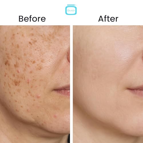 OMIC+ Skincare 7.5% Cysteamine Triple Complex Cream - 1.01 fl Oz / 30ml – Brightening & Tone-Improving Face Cream for Uneven Skin & Dull Complexion – Lightweight Texture