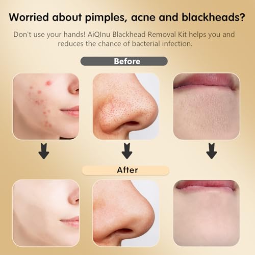 Miniatura 5 de Aiqinu 10 Piezas Puntos Negros Kit, Herramientas Para Eliminar Espinillas, Extractor De Acné Kit Blackhead Remover De Acero Inoxidable, Adecuado Para Espinillas, Acné Y Otras Impurezas De La Piel