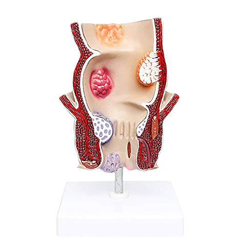 FHUILI Rektale Pathologische Modell - Anorektale Akne Pathologie Modell - Medizinische Lehre Hämorrhoiden Pathologie Modell - rektaler Darm Anatomisches Modell - für den Unterricht Study Anzeige Cover