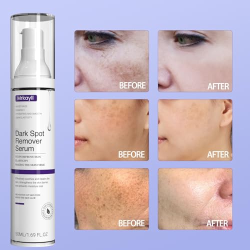 Tree Hut Dark Spot Remover Serum For Face, Dark Spot Corrector - Age Spot Sun Spot Freckles Melasma Brown Spot thumb #2