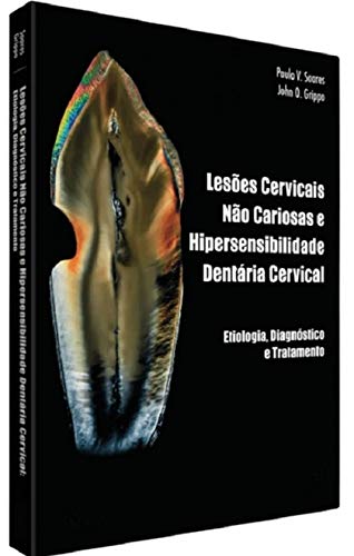 Lesões Cervicais não Cariosas e Hipersensibilidade Dentinária Cervical. Etiologia, Diagnóstico e Tratamento