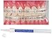 COMFORT LIP SHIELD / MOUTH GUARD - FOR BRACES - ORTHODONTIC - DENTAL