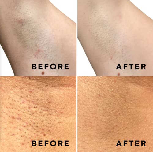 SweetSpot Labs Ingrown Hair Treatment I Brighten Dark Spots I Soothe Razor Burn I 50 Exfoliating Pads (2 Month Supply) Gentle Enough For Bikini Area I Buff & Brighten