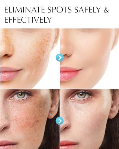 Enaskin Dark Spot Remover For Face And Body: Hyperpigmentation Treatment - Freckle/Melasma/Sun Spot/Age Spot Remover thumb #1