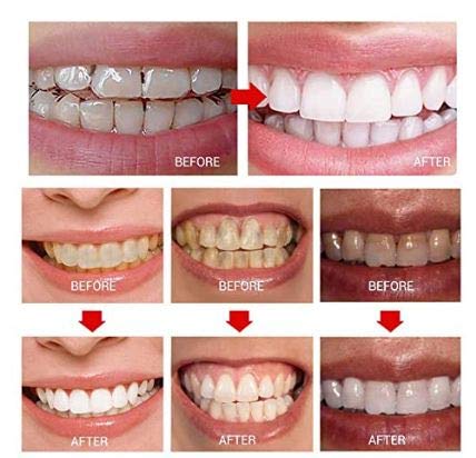 Professional Mint Flavor Advanced Teeth Whitening Strips for Sensitive Teeth 2