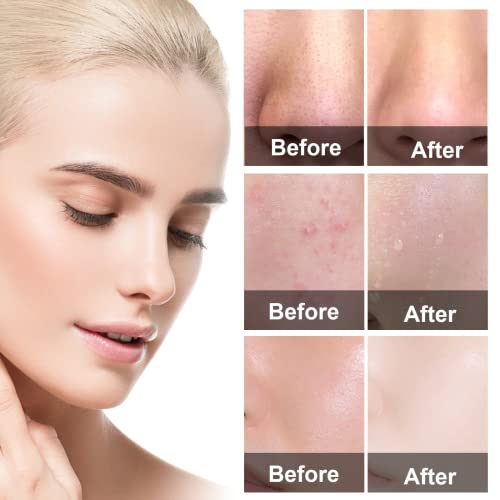 Oewwex Green Tea Mask Clay Stick Blackhead Remover Pore Strips Combo Pack, 10 Pc Blackhead Acne Remover Patches Improve Skin Of Men And Women Deep Pore Cleansing #TOP5